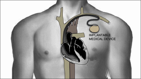 Implantable Device